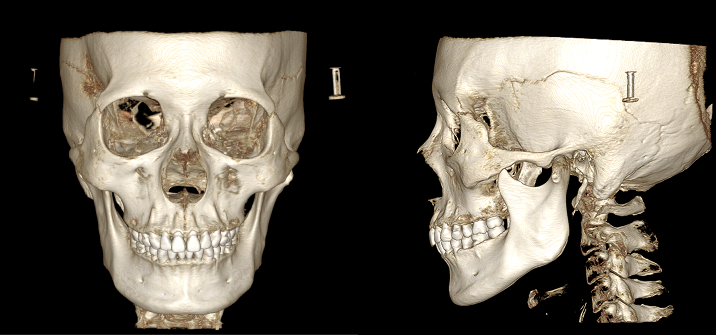 Bone rendering